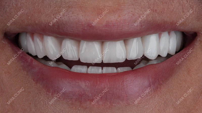 The Final Restoration: 28 Zirconium Crowns